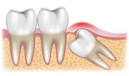Disimpaction / 3rd Molar